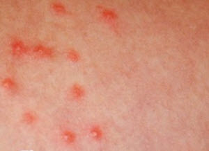 Human Flea Bite Allergies