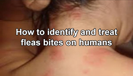  Fleas on People